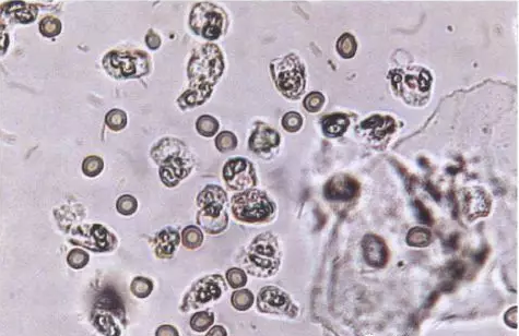 全自动阴道分泌物麻豆影视在线直播视频剖析阴道分泌物的洁净度规范