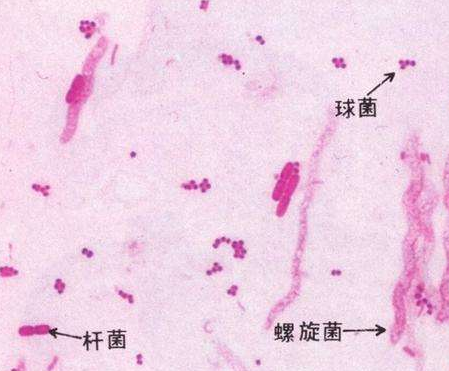 妇科白带麻豆影视在线直播视频厂家分析白带线索细胞阳性的意义