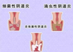 全自动阴道分泌物麻豆影视在线直播视频厂家提醒您还在拖延吗，还在等阴道炎自愈吗？